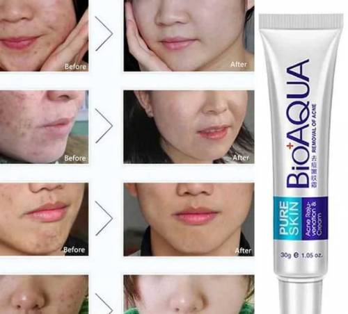  Acne Scar Removal Rejuvenation Cream, 30 G