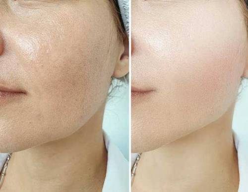 whitening cream 