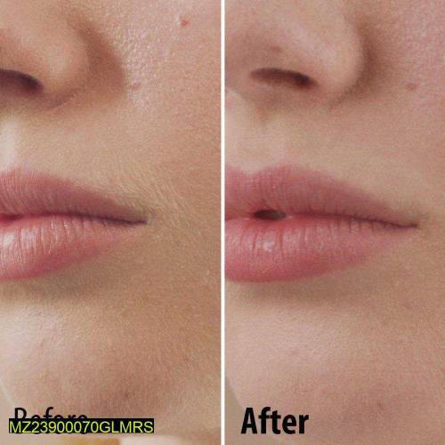 facial Hair removal machine 