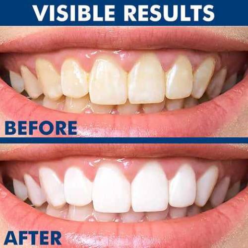Teeth whitening pen