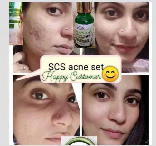 Acne Treatment  Set ... Organic Skin Care Products