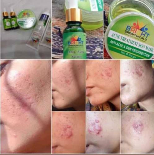 Acne Treatment  Set ... Organic Skin Care Products