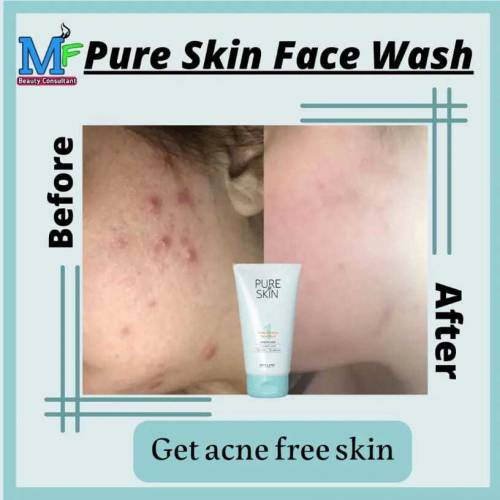 pure skin face wash for pimple issues 