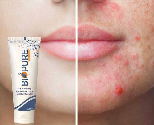 Acne Cream