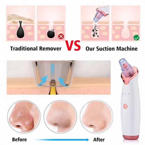 Vacuum Blackheads Remover 
