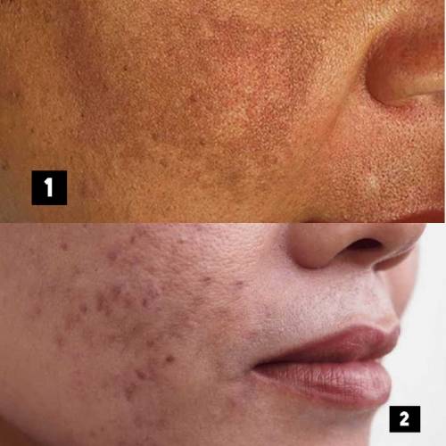 for all skin problem one solution pimple pigmentation dullness 